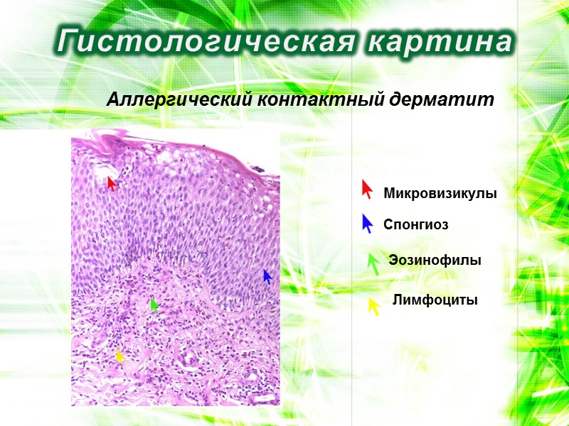 Гистологическая картина Аллергический контактный дерматит Микровизикулы Спонгиоз Эозинофилы Лимфоциты